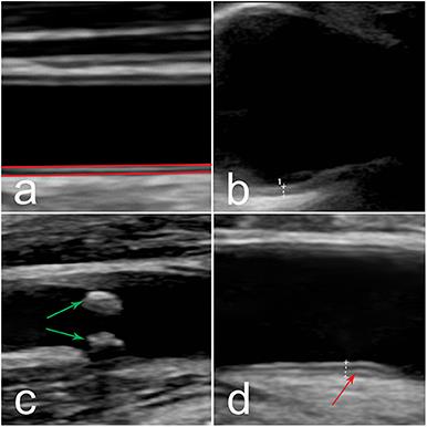 High-Frequency Ultrasound of Multiple Arterial Areas Reveals Increased Intima Media Thickness, Vessel Wall Appearance, and Atherosclerotic Plaques in Systemic Lupus Erythematosus